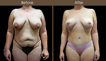 Before And After Mommy Makeover Surgery In NY